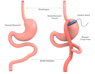 bariatric surgery, Steve Parker MD
